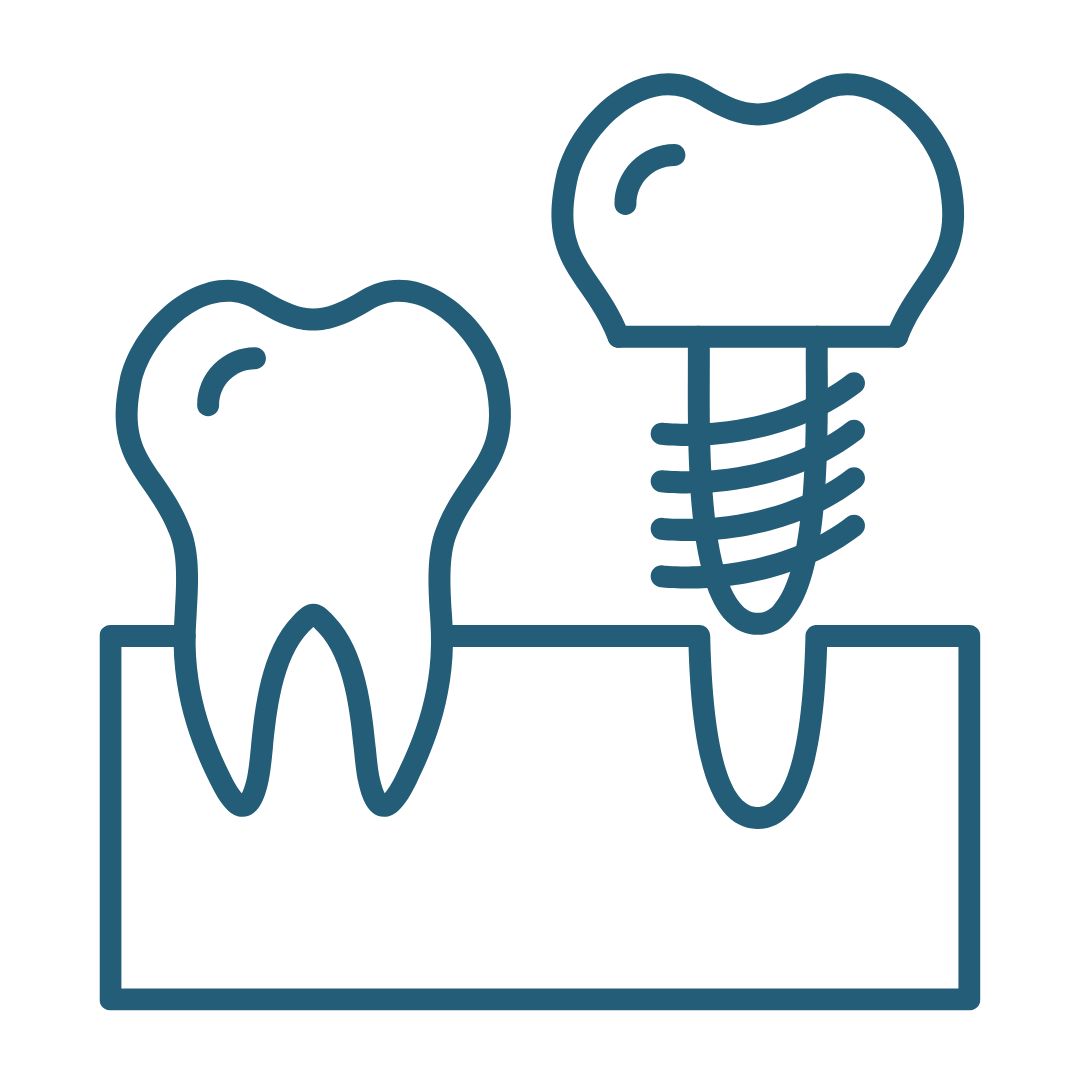 Implantes Dentales de Calidad en Teatinos - Málaga-