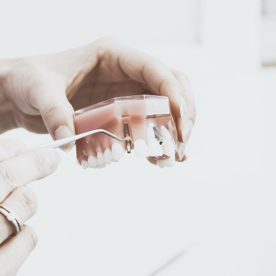 Implantes Duraderos en Teatinos - Malaga-