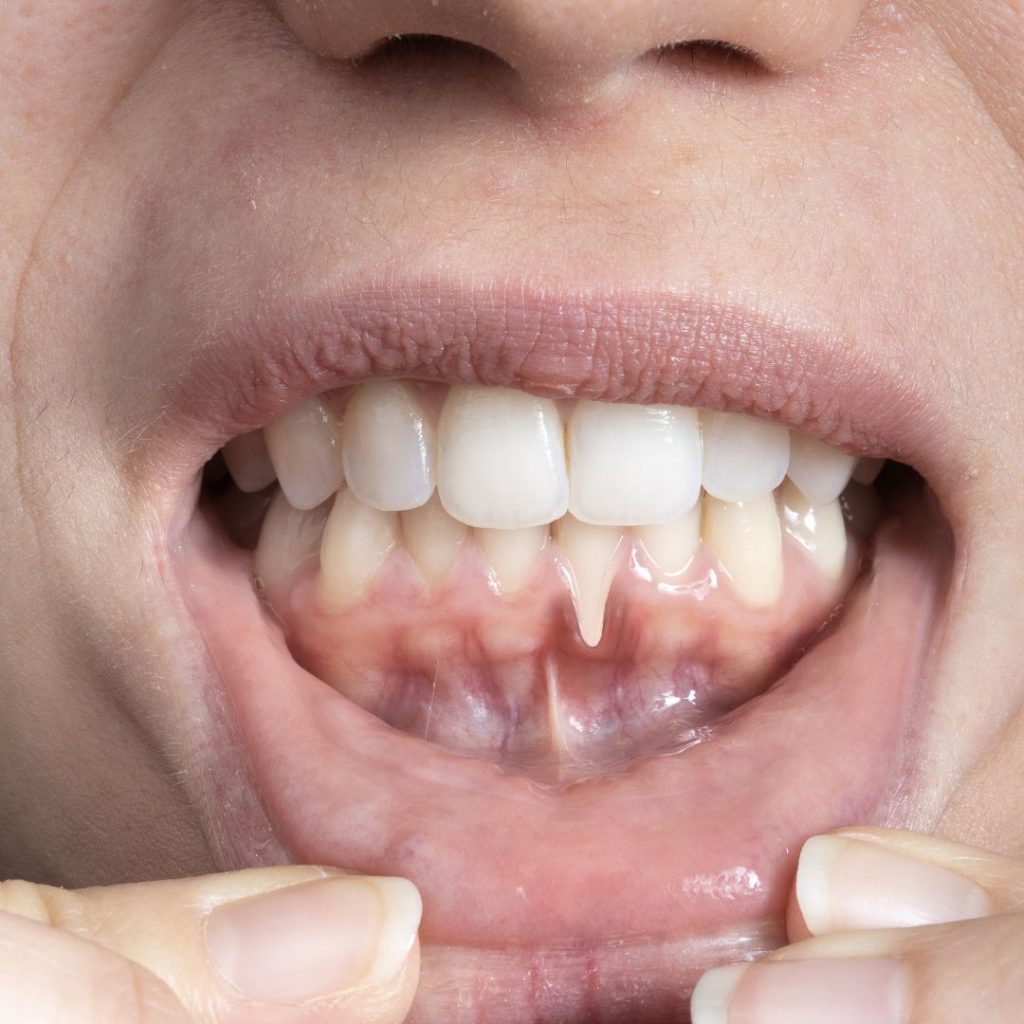 Cirugía Periodontal_Clínica Dental Requena