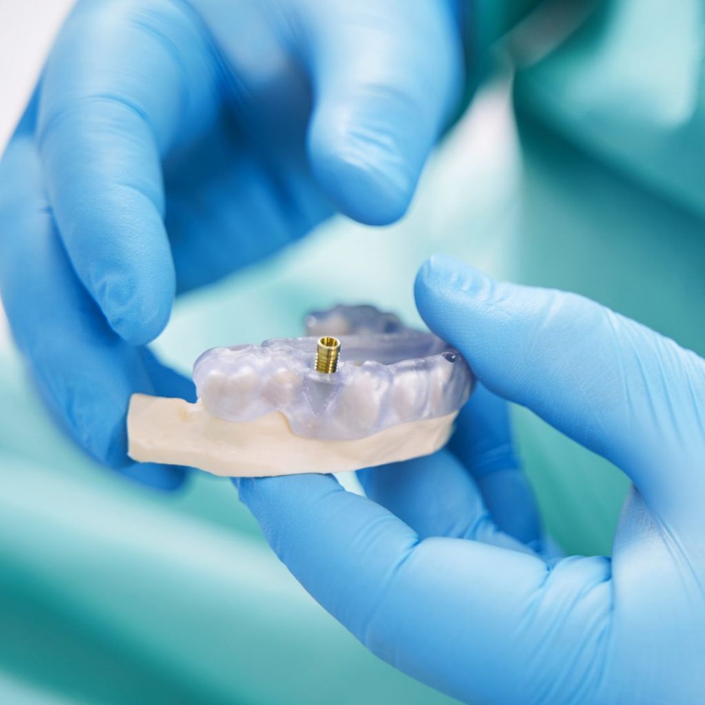 Implantes Dentales y Osteointegración