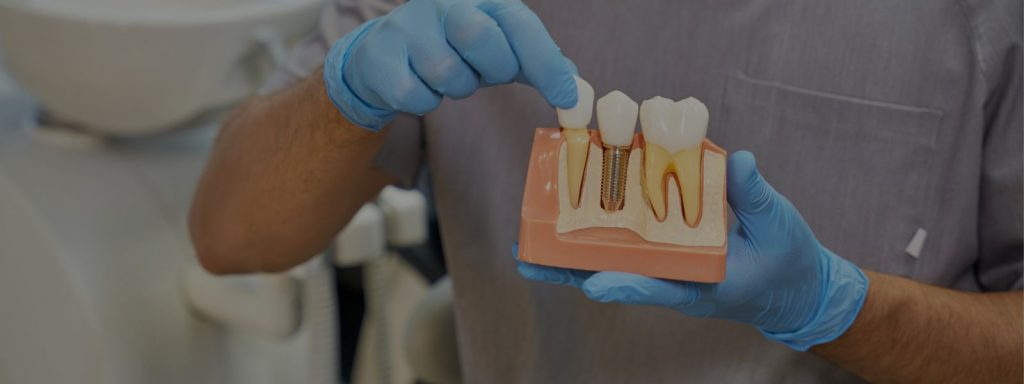 Implantes Dentales y Osteointegración